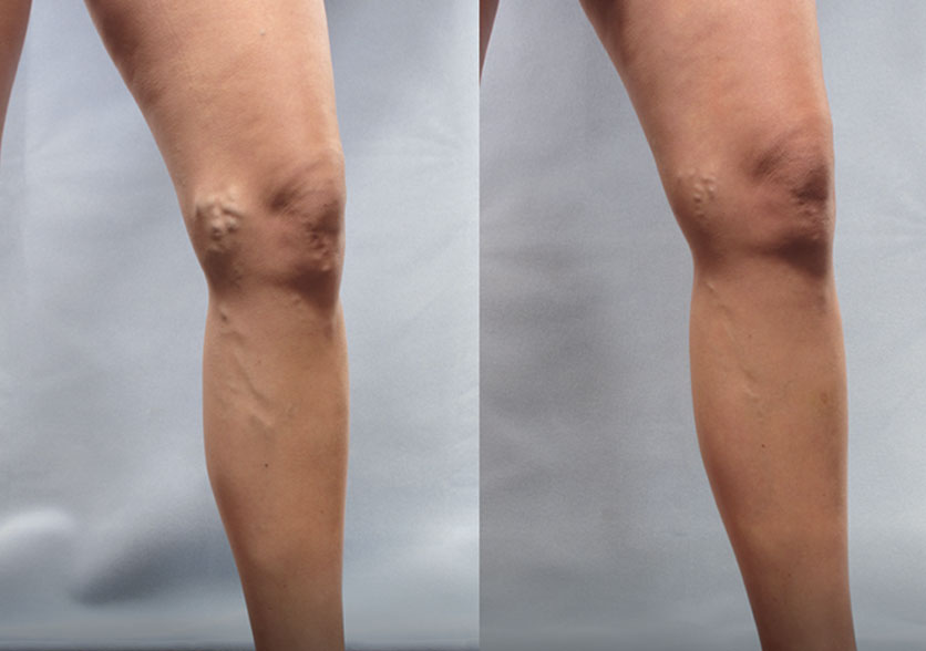 Before-and-after comparison of a patient treated with Varithena, illustrating visible improvements in varicose veins.