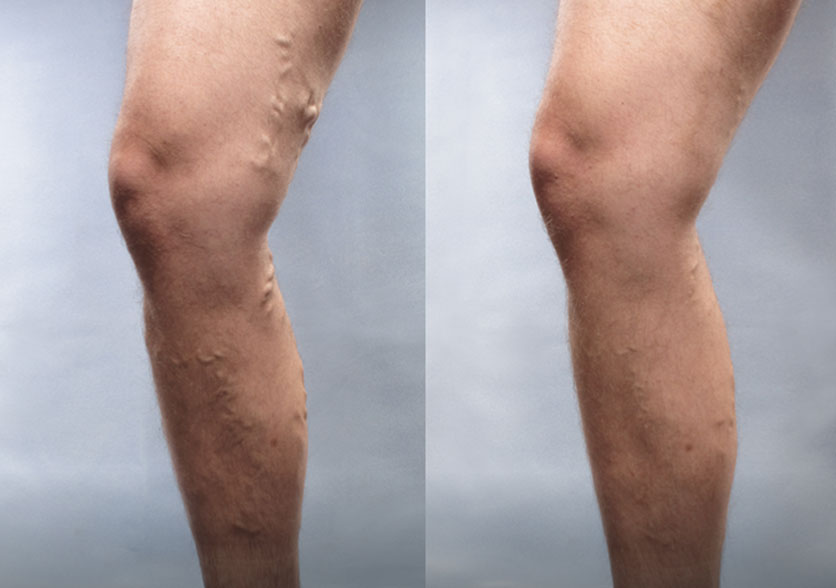 Before-and-after comparison of a patient treated with Varithena, illustrating visible improvements in varicose veins.
