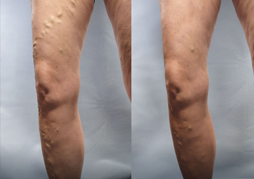 Before-and-after comparison of a patient treated with Varithena, showcasing significant improvement in the appearance of varicose veins.