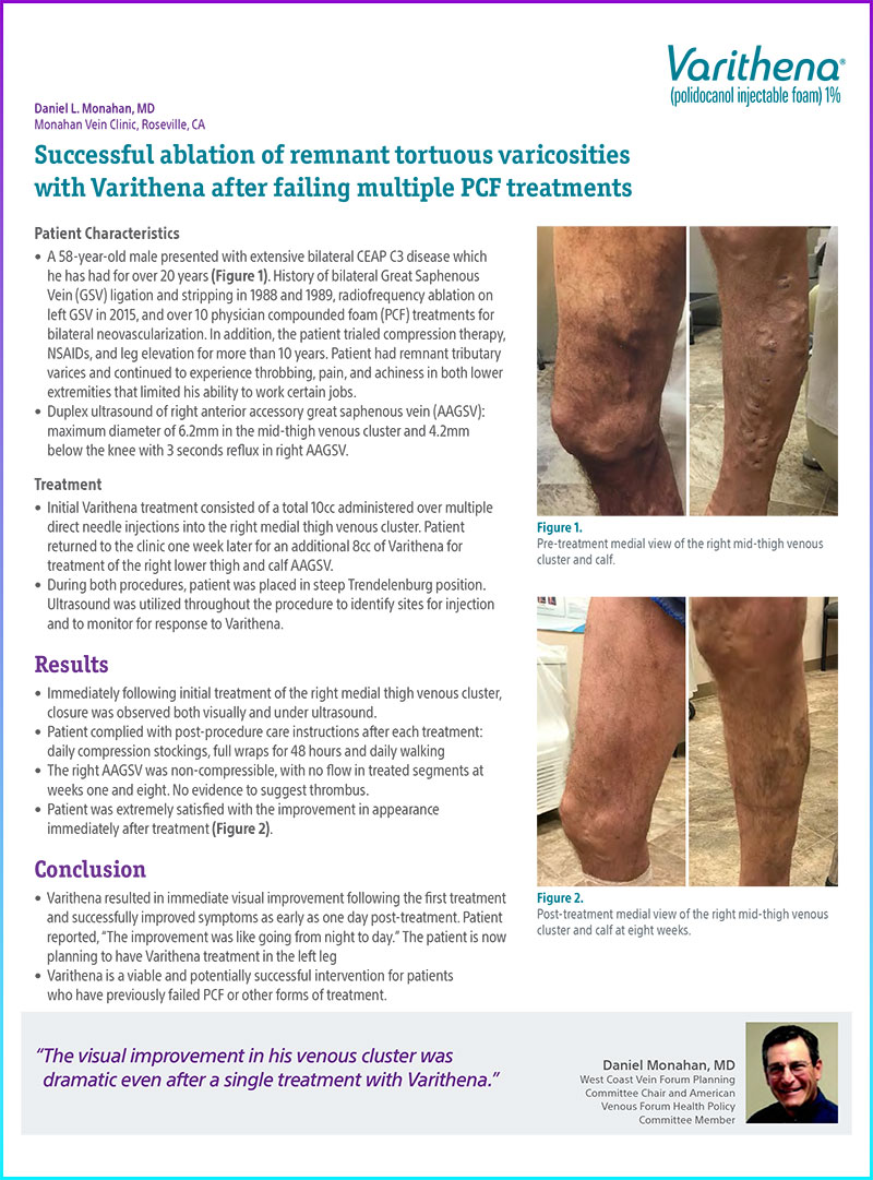 Case study by Monahan on Varithena's clinical outcomes for varicose veins, focusing on patient improvement and satisfaction.