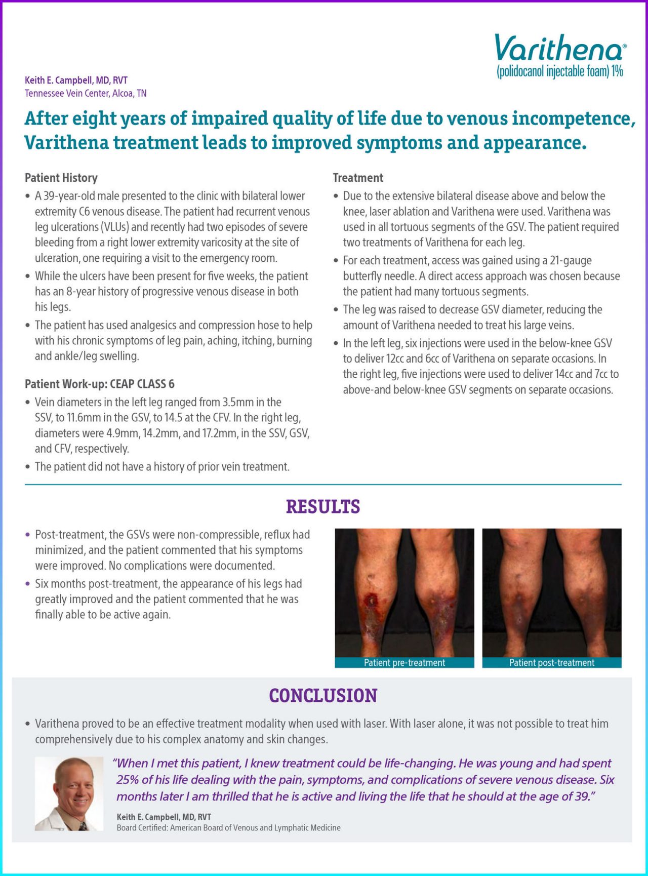 After eight years of impaired quality of life due to venous incompetence, Varithena treatment leads to improved symptoms and appearance.