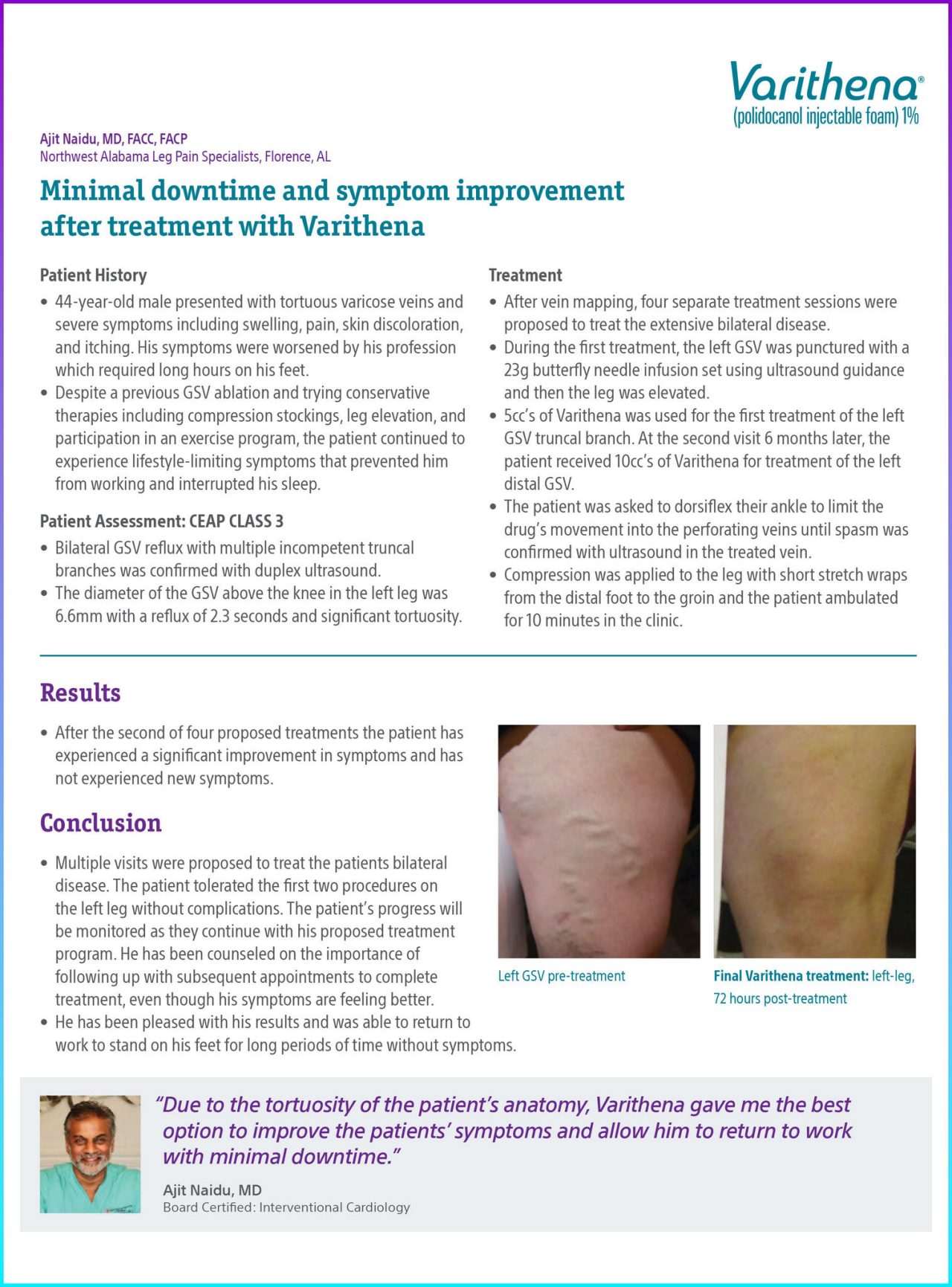 Case study by Naidu demonstrating the effectiveness of Varithena in treating varicose veins, with notable improvements in symptoms and patient satisfaction.