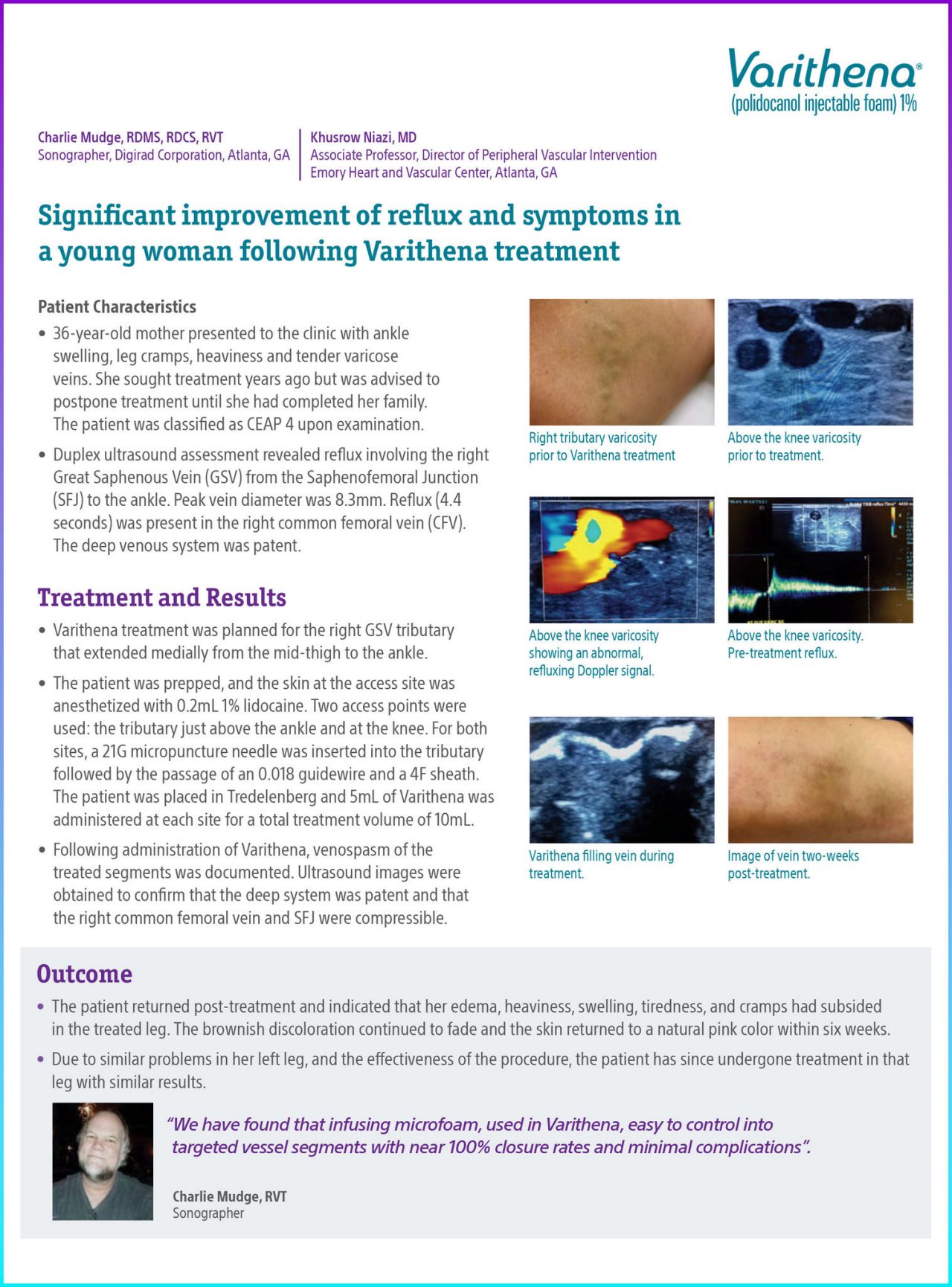 Case study by Mudge highlighting the success of Varithena treatment in improving symptoms of varicose veins and enhancing patient quality of life.